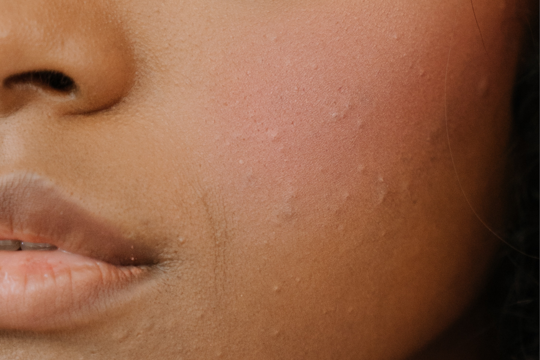 Acné sur peau noire : soins efficaces et non irritants