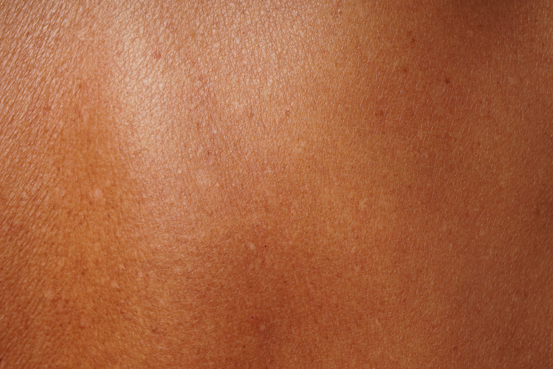 Taches post-acné sur peau foncée : soins et prévention