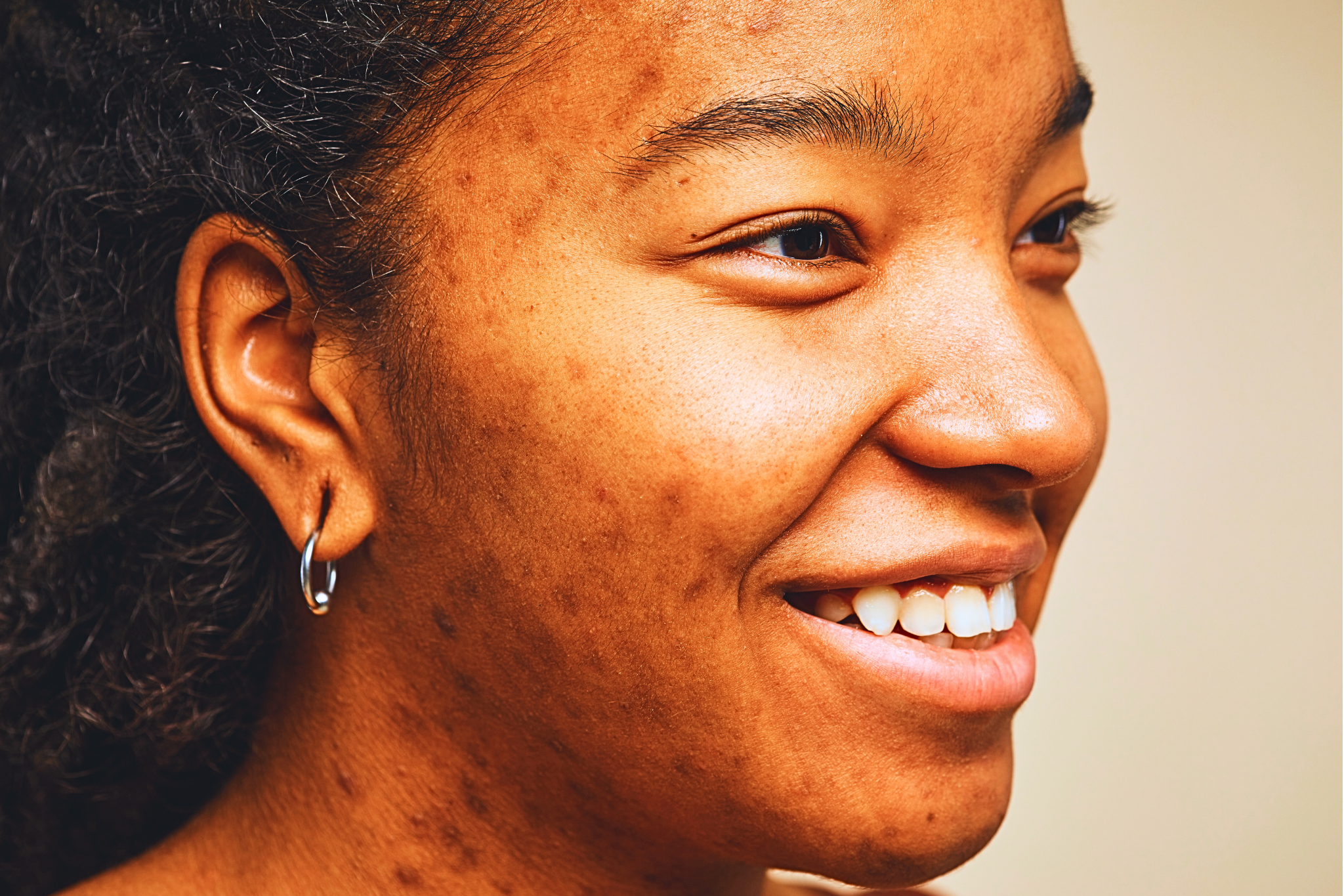  Comment mettre fin à l’acné adulte définitivement en 6 étapes?