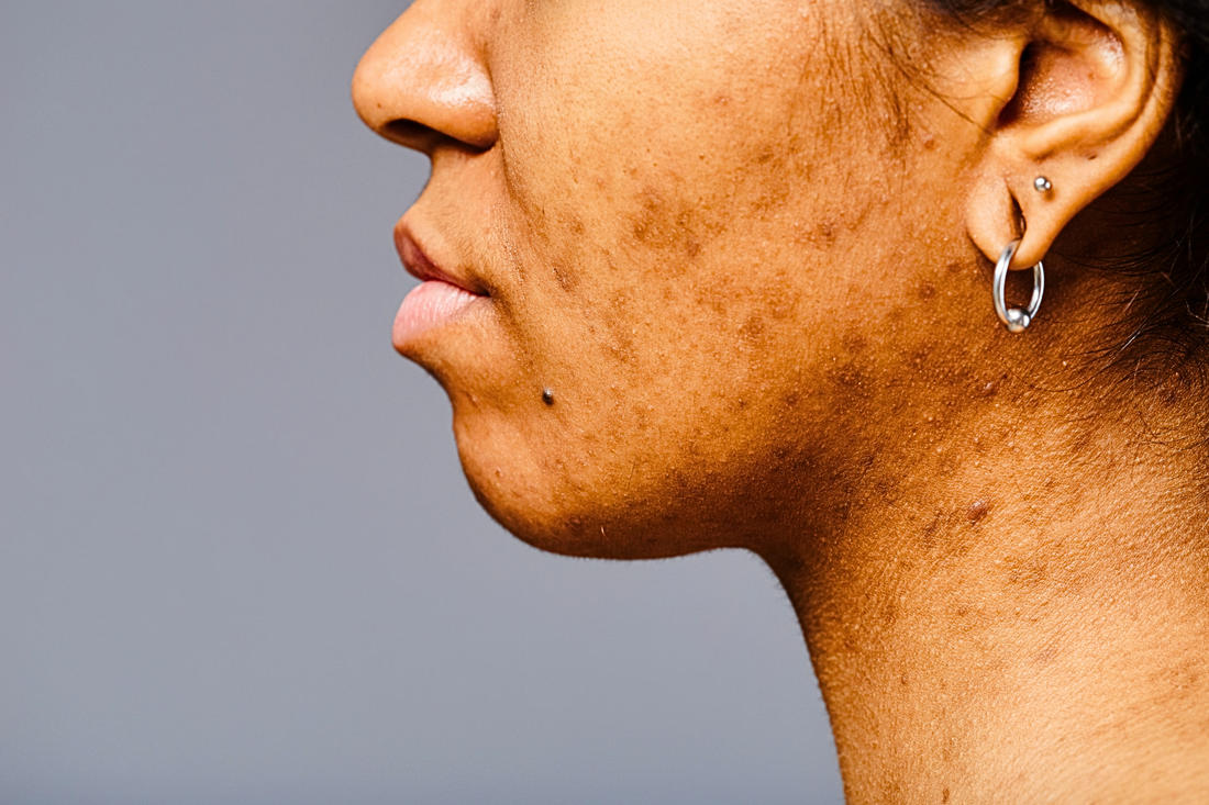 Comment faire disparaître mes taches pigmentaires rapidement ?